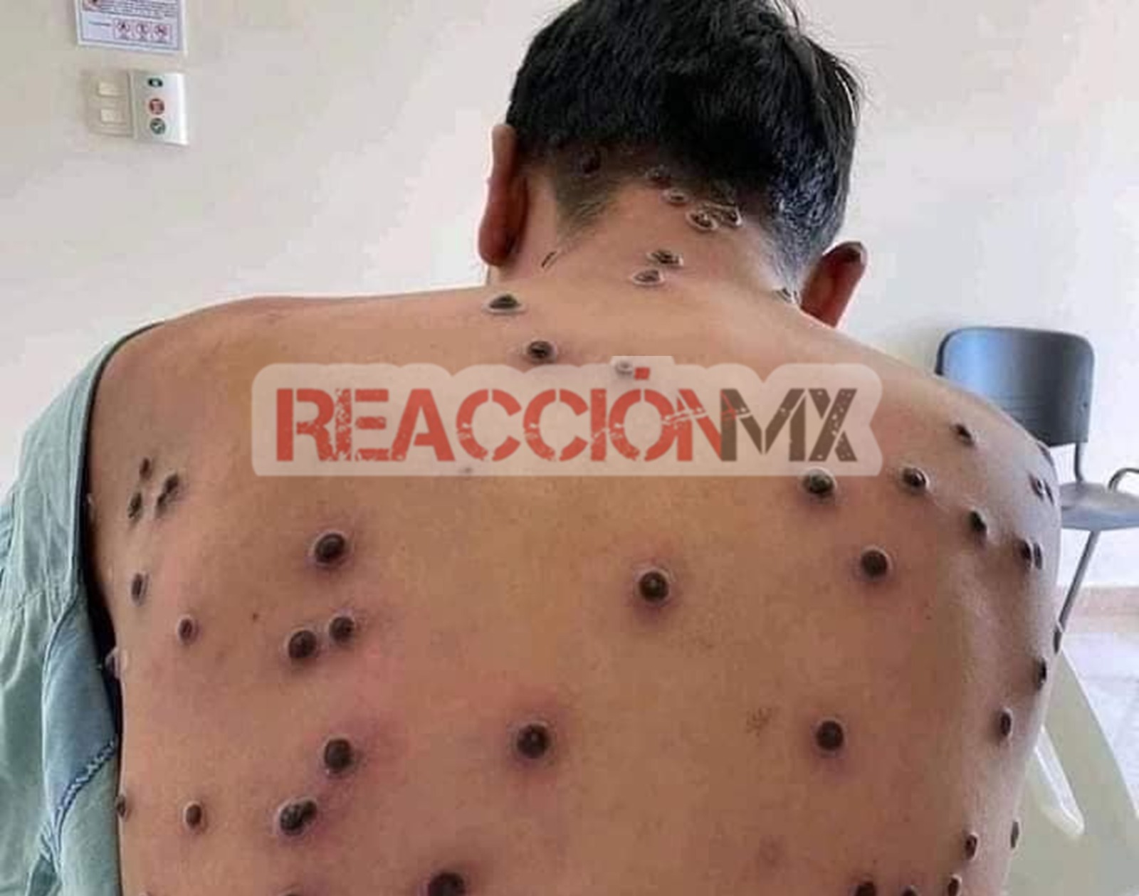 Bajan de plataforma a obreros con presuntos casos de Viruela Símica al IMSS.