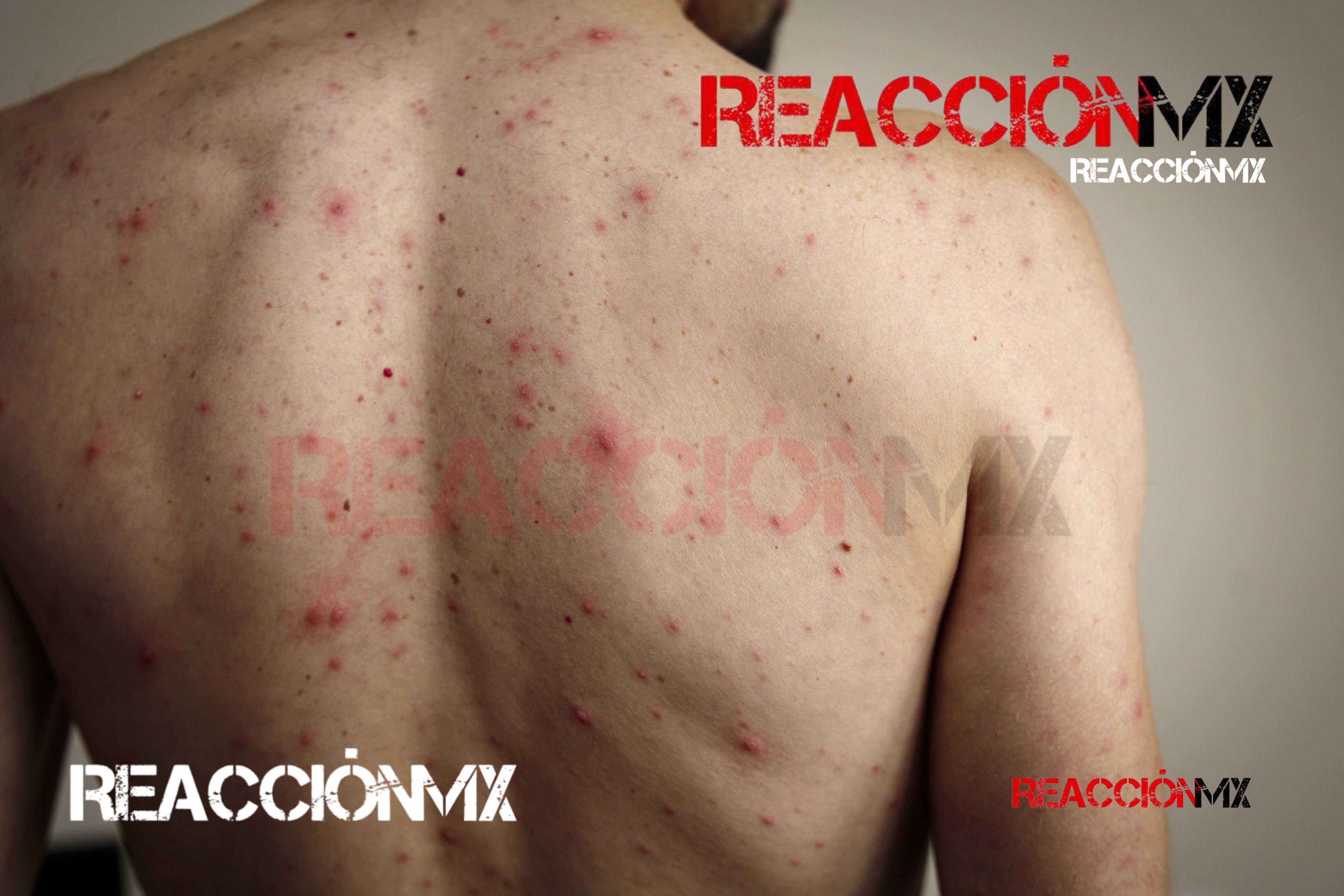 Detecta Salud segundo caso de Sarampión en Tabasco.